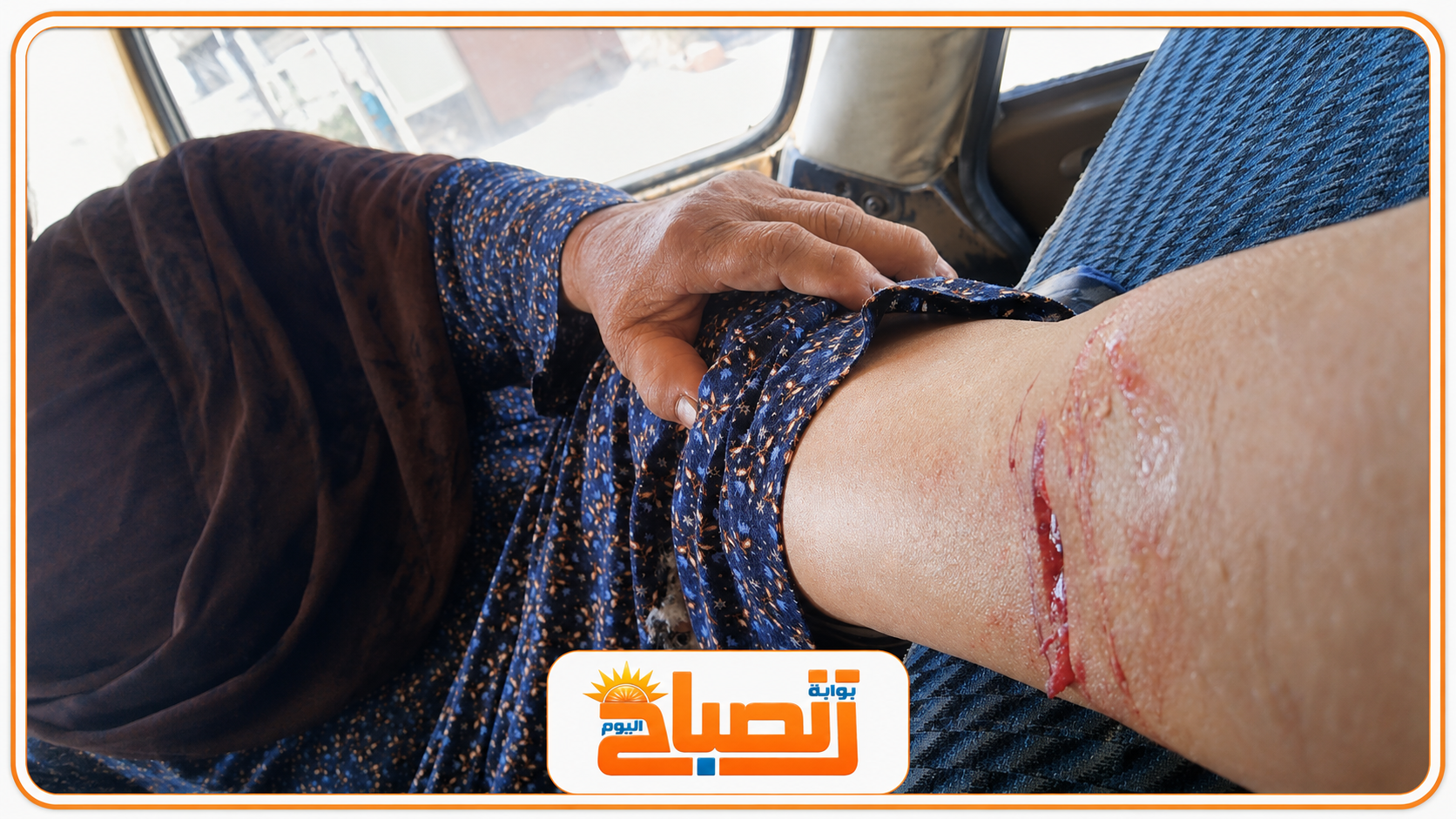 بالصور :كلب  يعقر سيدة مسنة في مشتول السوق.. وتحويلها لجامعة الزقازيق